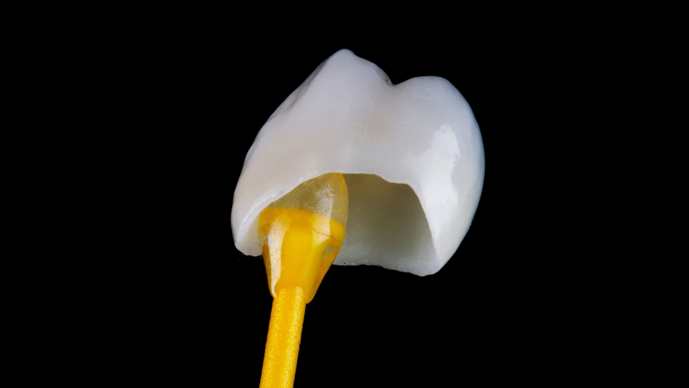 Diseño de sonrisa - carillas de porcelana
