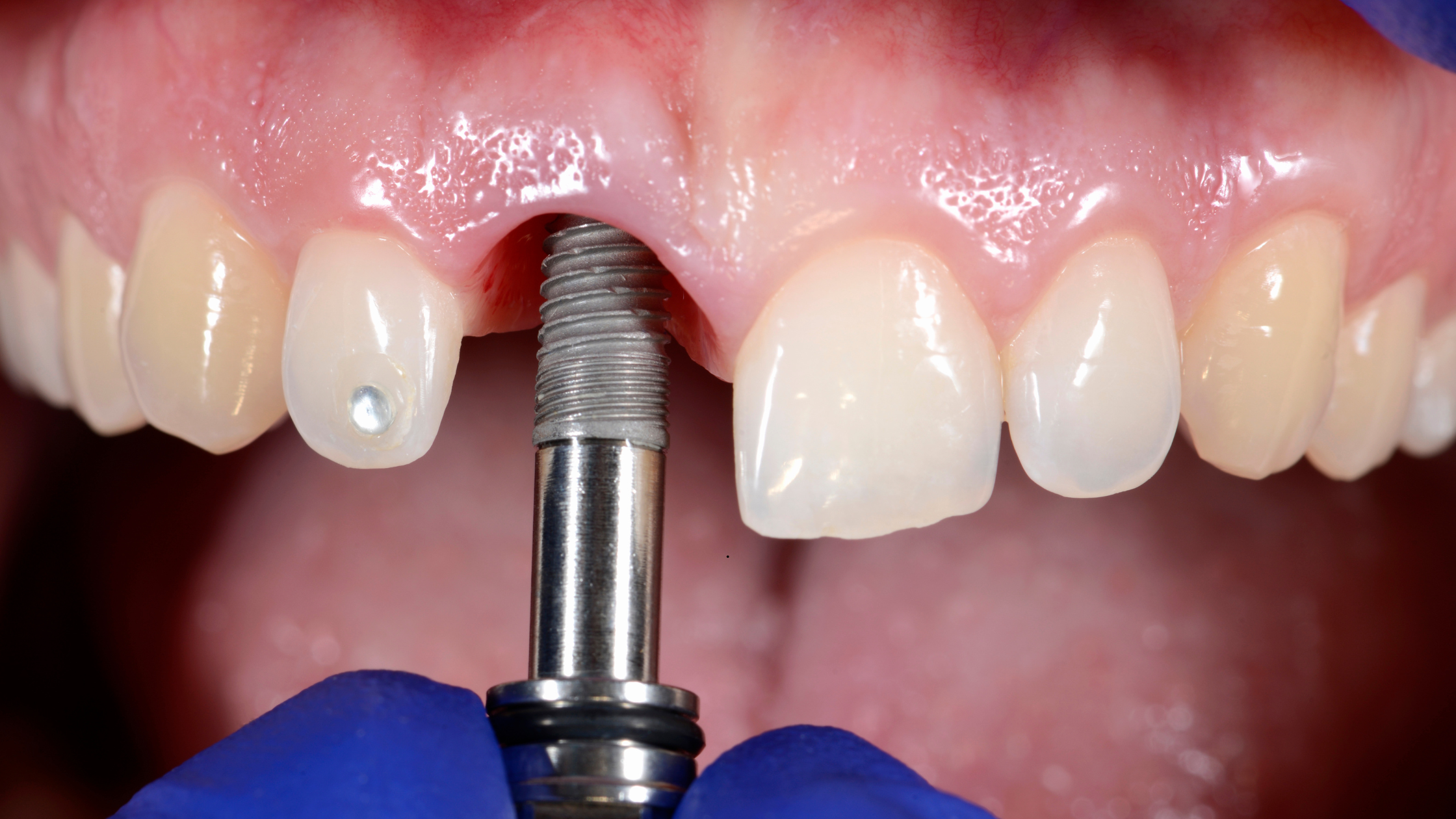Implante Dental Costa Rica