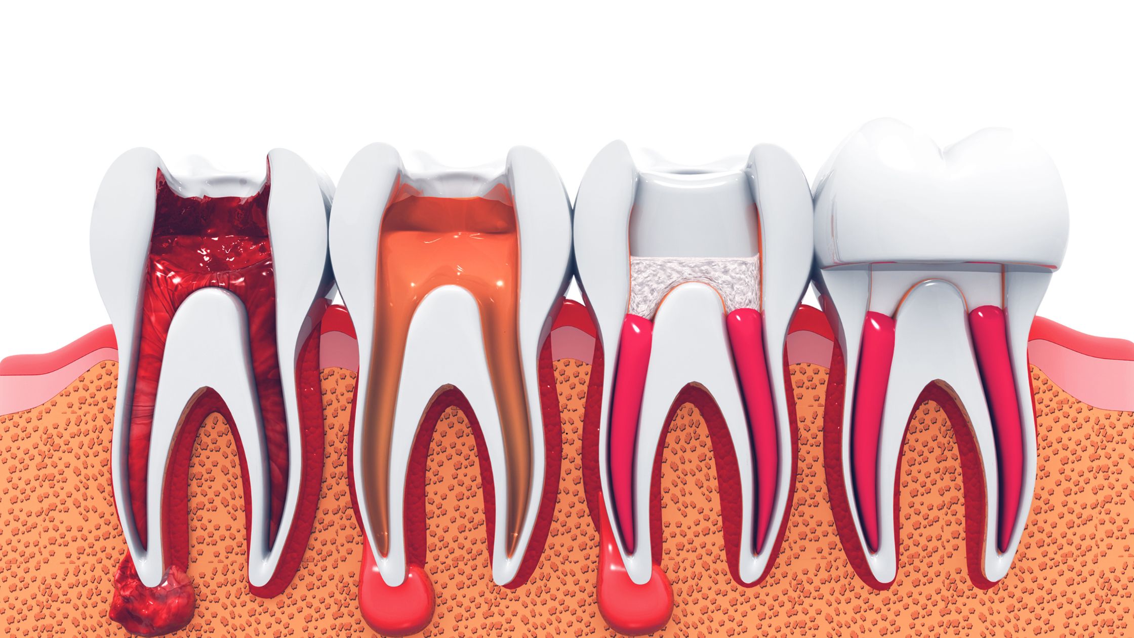 Endodoncia en Heredia