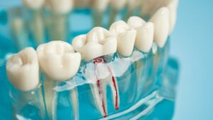 Endodoncia en Costa Rica