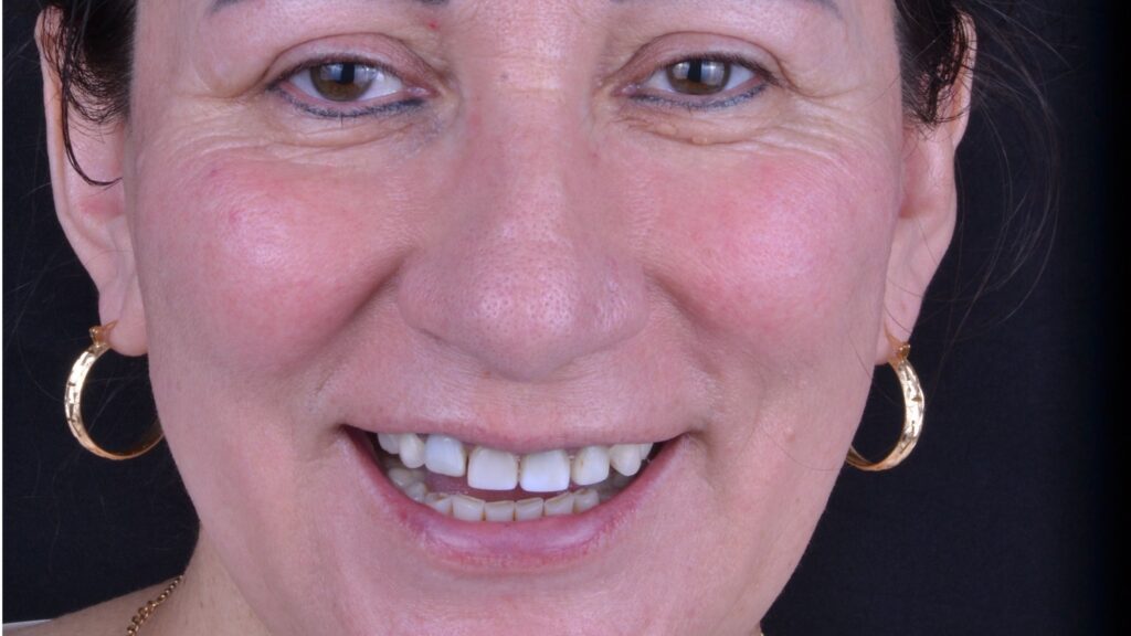 Restaurativa dental antes