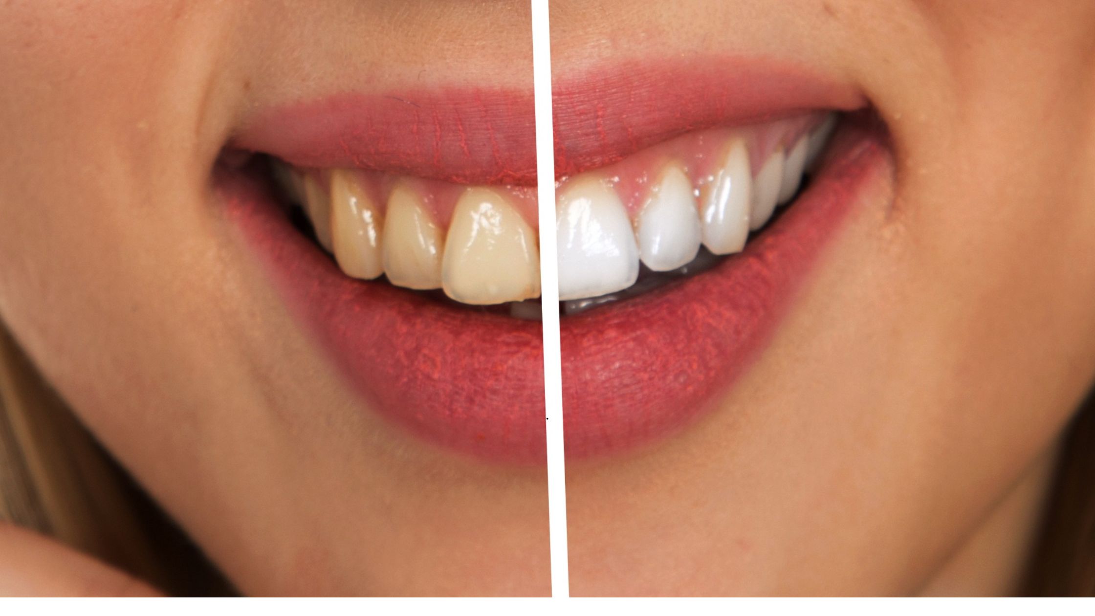 Blanqueamiento dental en Heredia