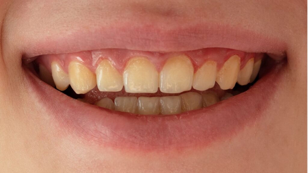 Dientes manchados