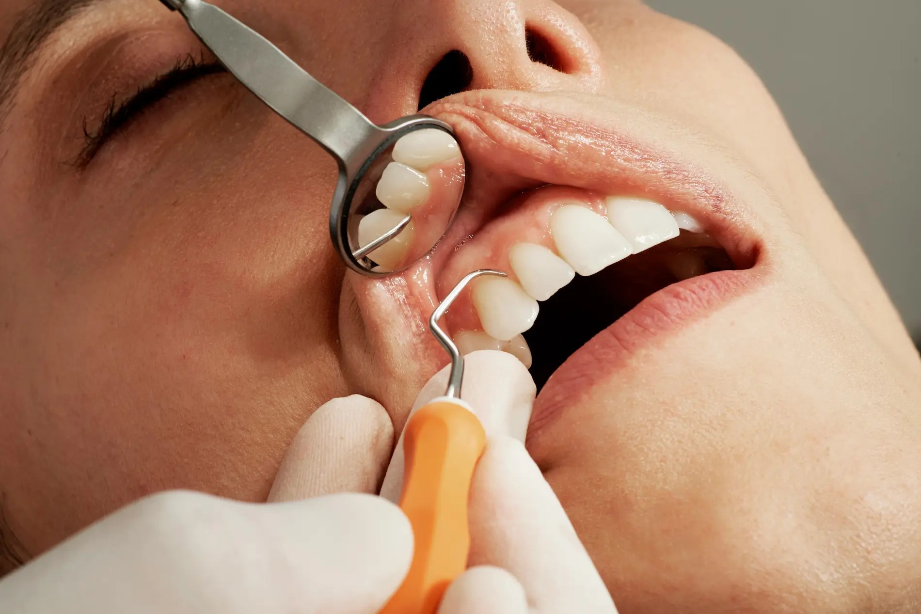 taratamiento de encias, enfermedad periodontal Heredia