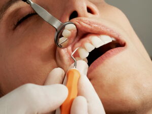 Limpieza dental profesional para eliminar sarro y cuidar la salud de las encías